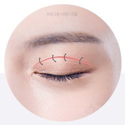 피부 봉합
