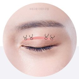 근육 매듭