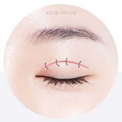 피부 봉합