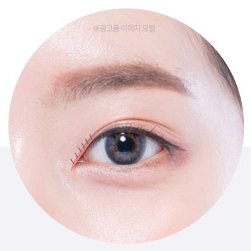 피부 봉합