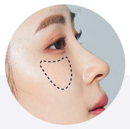 옆광대 부위를 점선으로 표시한 옆얼굴