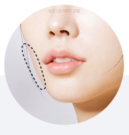 심술보·볼살 부위를 점선으로 표시한 입가