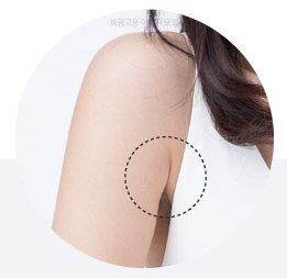 겨드랑이 라인 원형 클로즈업 — 점선 원으로 시술 부위 표시