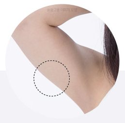 팔 안쪽 원형 클로즈업 — 점선 원으로 시술 부위 표시