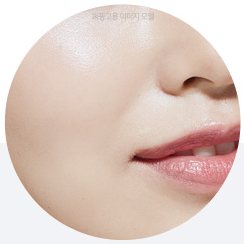 시술 부위 원형 사진 — 팔자주름(코 옆·입가)